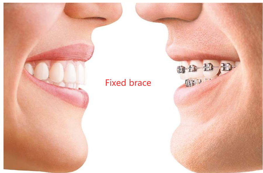 Fixed brace